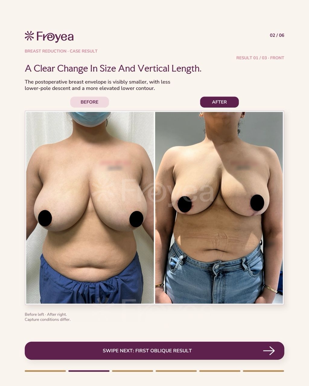 What Actually Happens in a Breast Reduction Consultation - Result 2