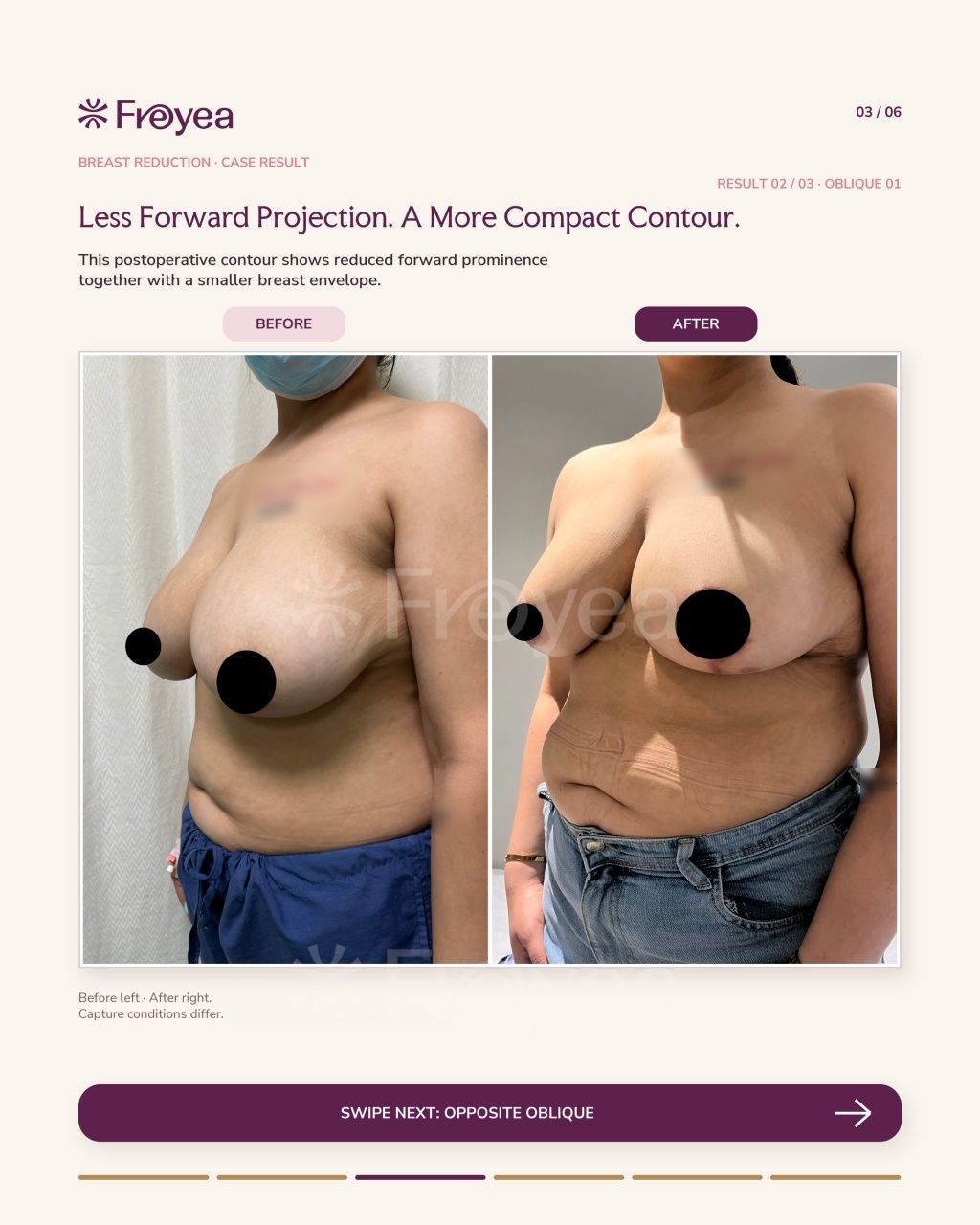 What Actually Happens in a Breast Reduction Consultation - Result 3