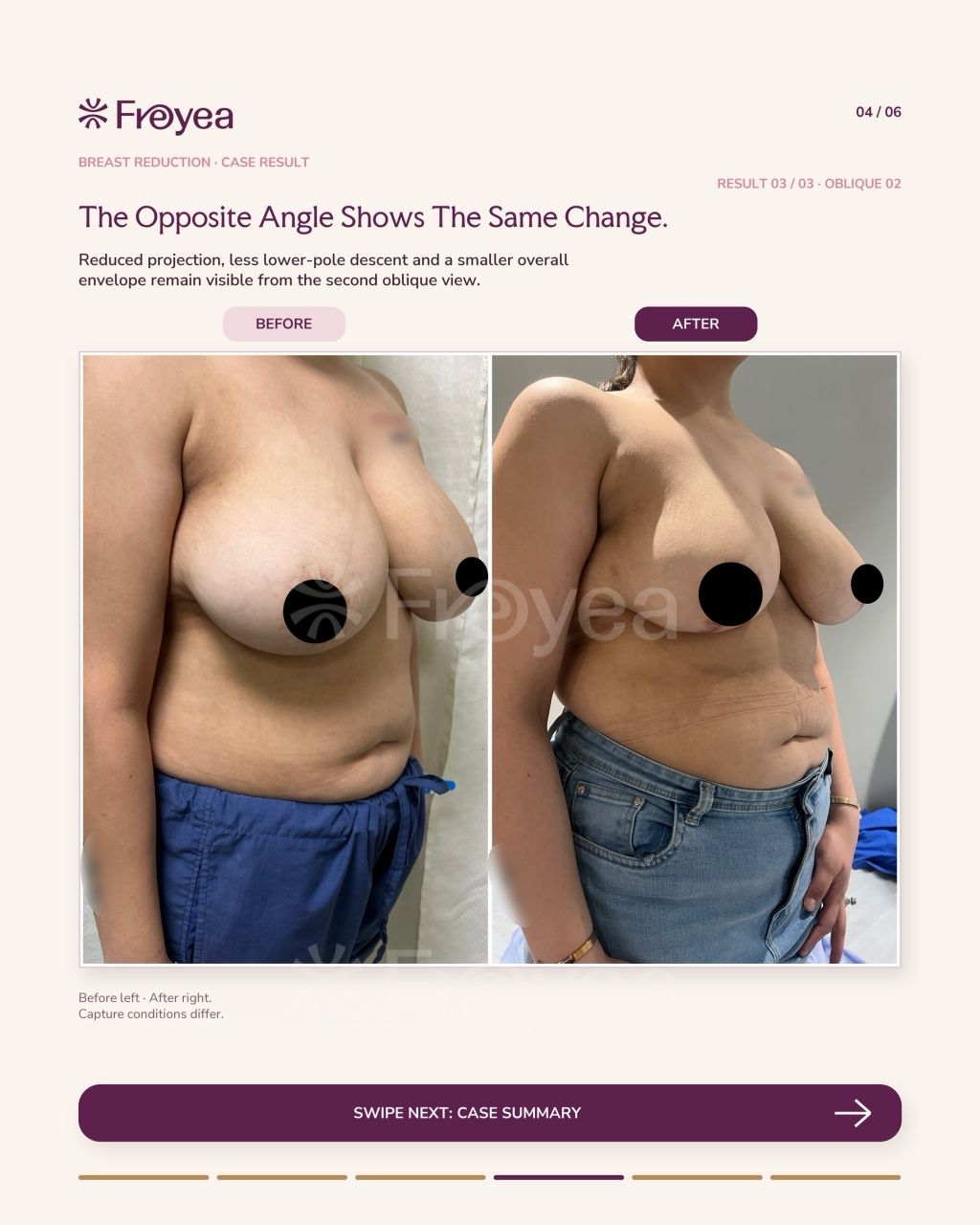 What Actually Happens in a Breast Reduction Consultation - Result 4