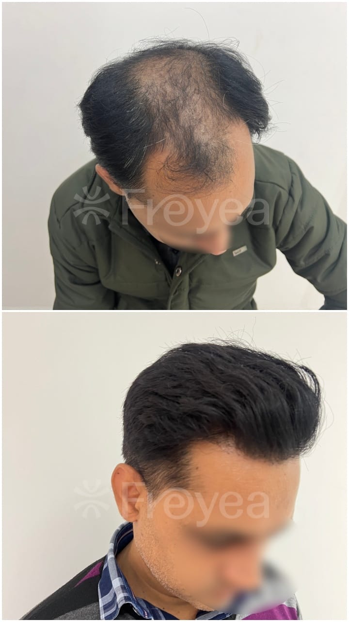 Inside a Hair Transplant Consultation in South Delhi: Why the First Twenty Minutes Are Not About Hair - Result 1