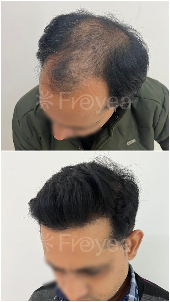 Inside a Hair Transplant Consultation in South Delhi: Why the First Twenty Minutes Are Not About Hair - Result 2