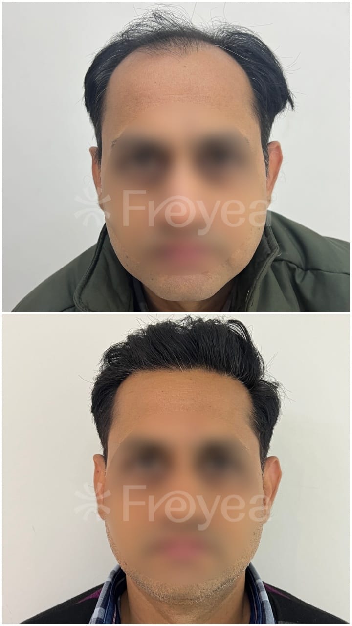 Inside a Hair Transplant Consultation in South Delhi: Why the First Twenty Minutes Are Not About Hair - Result 3