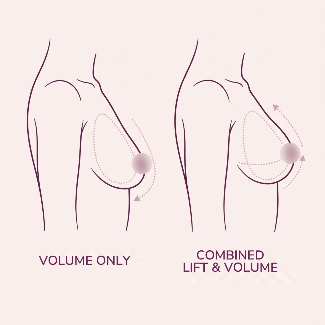 Click to expand Combined Breast Lift and Augmentation Mastopexy