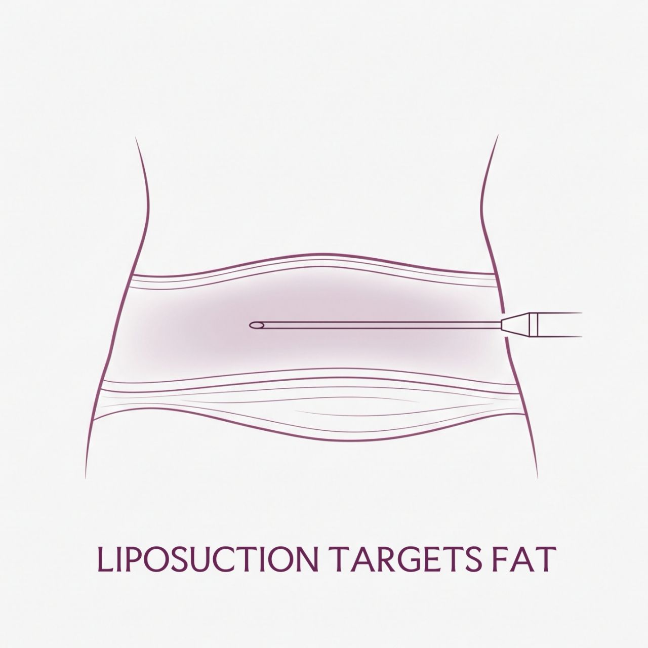 Liposuction Procedure and Recovery